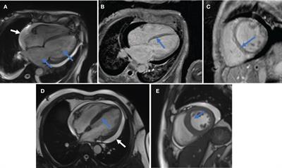 Myocardial involvement is not rare in anti-melanoma differentiation-associated gene 5 antibody-positive dermatomyositis/clinically amyopathic dermatomyositis: a retrospective study